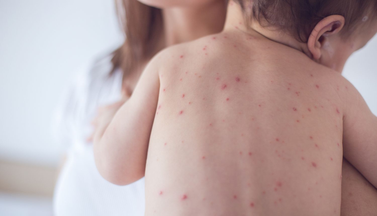 وزارة الصحة تعلن عن ارتفاع عدد حالات الحصبة في بلادنا