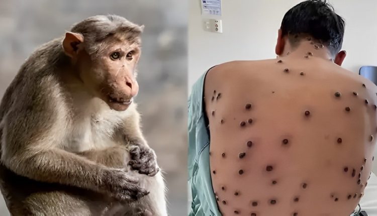 عدد الوفيات بسبب جدري القردة يسجل ارتفاعا مقلقا