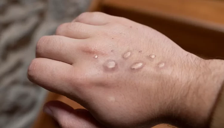 جدري القردة