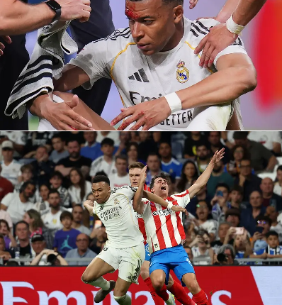 إصابة في الوجه يثير القلق قبل مواجهة بايرن ميونخ في دوري أبطال أوروبا.