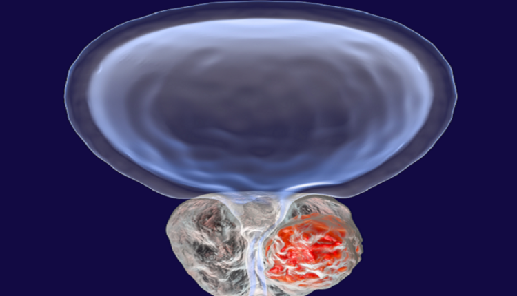 اكتشاف جديد يفسر تطور سرطان البروستاتا